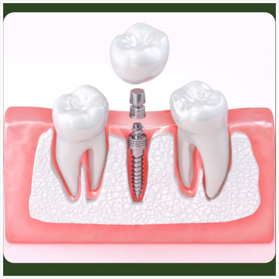 Why Should You Be Careful About Drinking After an Implant? image 5