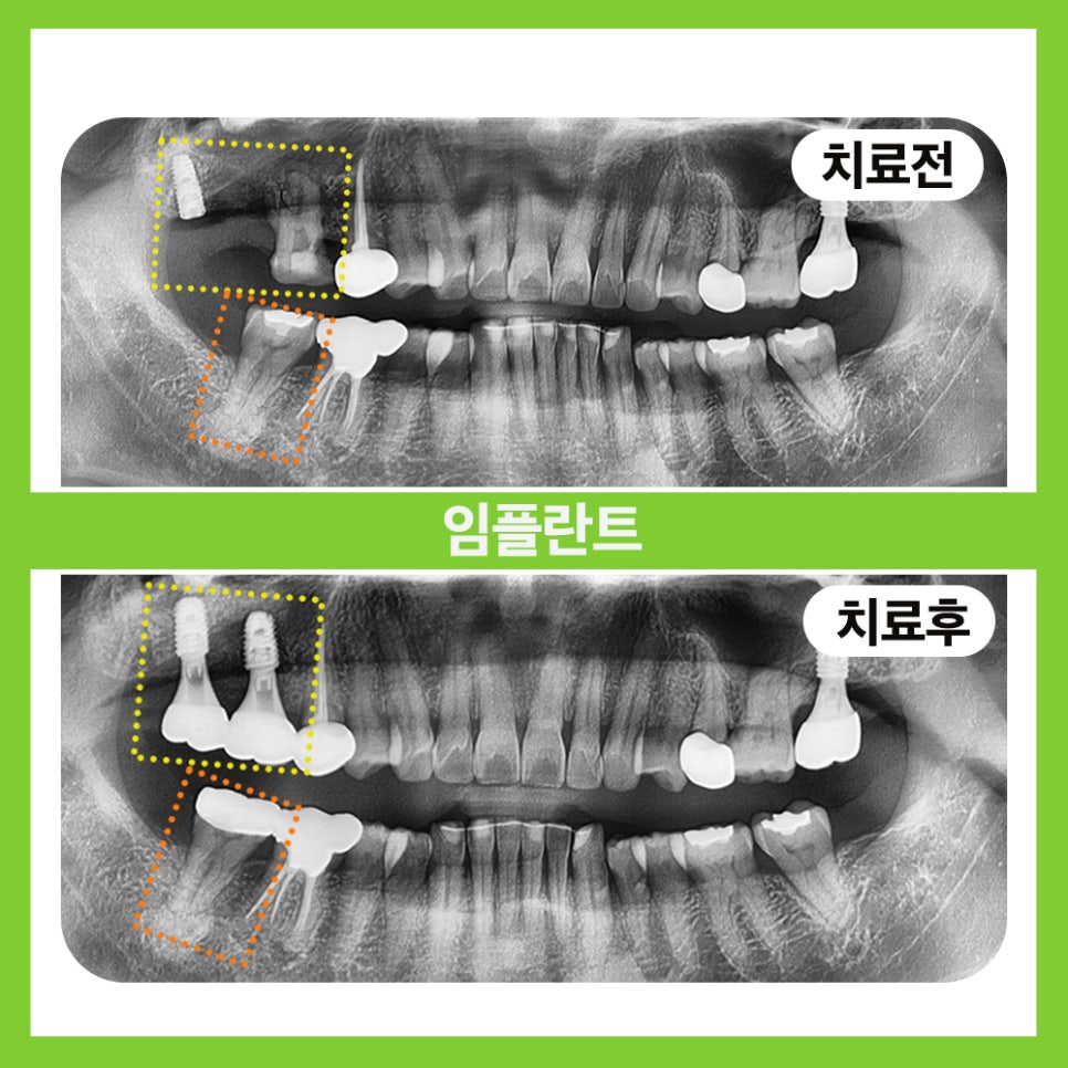 Songpa-gu Dental Clinic: Solving a Case Where Prosthetics Were Impossible with Implant Reoperation! image 1