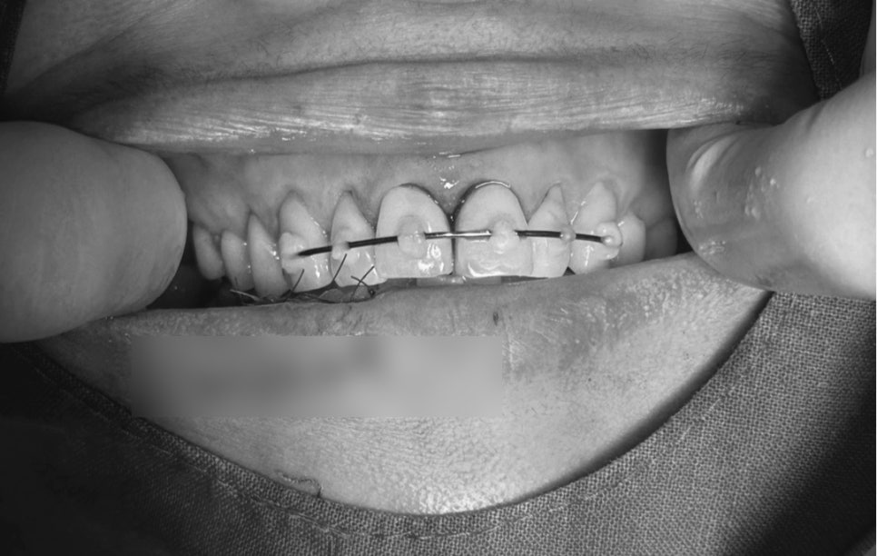 Treatment Process Revealed for a Fall That Injured Both the Front Teeth and Lip image 13