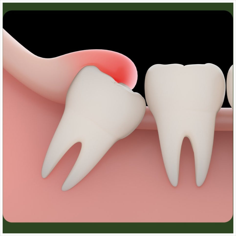 Swelling After Wisdom Tooth Extraction: How Can You Reduce It Quickly? image 2