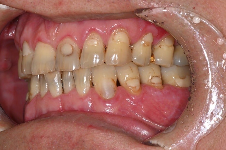 Jamsil Dental Hospital Implant Price and Treatment Case image 5