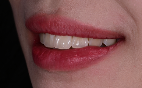 Objeo Laminate Cost, Treatment Review from a Woman in Her 20s image 8