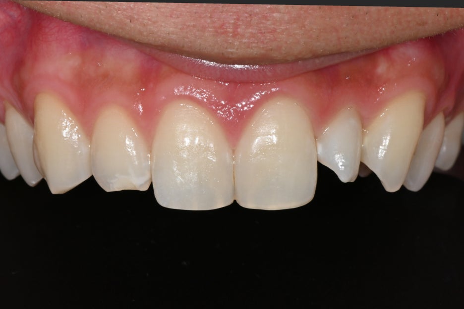 Object Zero Front Tooth Laminate, Minimizing Tooth Reduction image 16