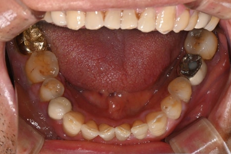 Is the bleeding from your gums not stopping? A case that raised suspicion of leukemia image 2