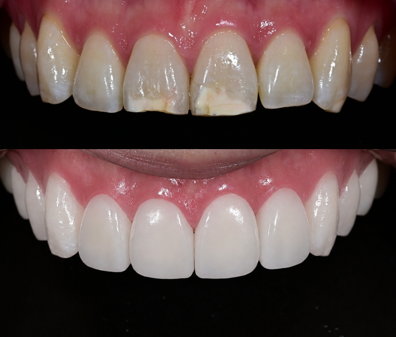 Songpa Dental Clinic: A Case of Improving Mottled Teeth with Veneers image 10