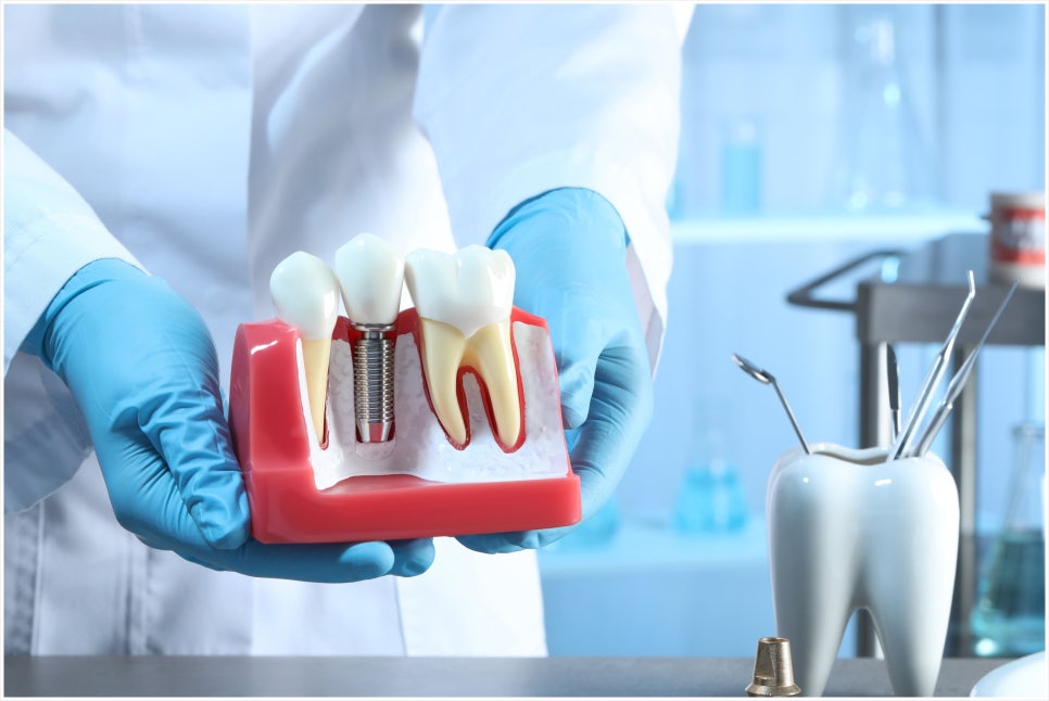 What Is Second-Stage Implant Surgery? Find Out Here! image 6