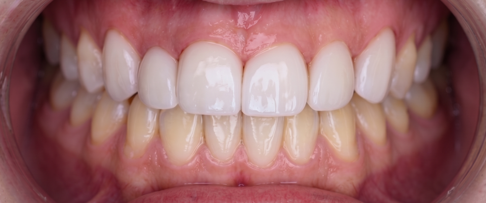 Why the Front Teeth Laminate Changed Naturally with Obzero Laminate image 12