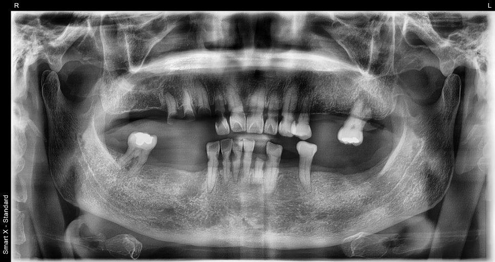 Full-Mouth Implant Price: Treatment for a Patient Over 65 Performed Under Sedation image 2