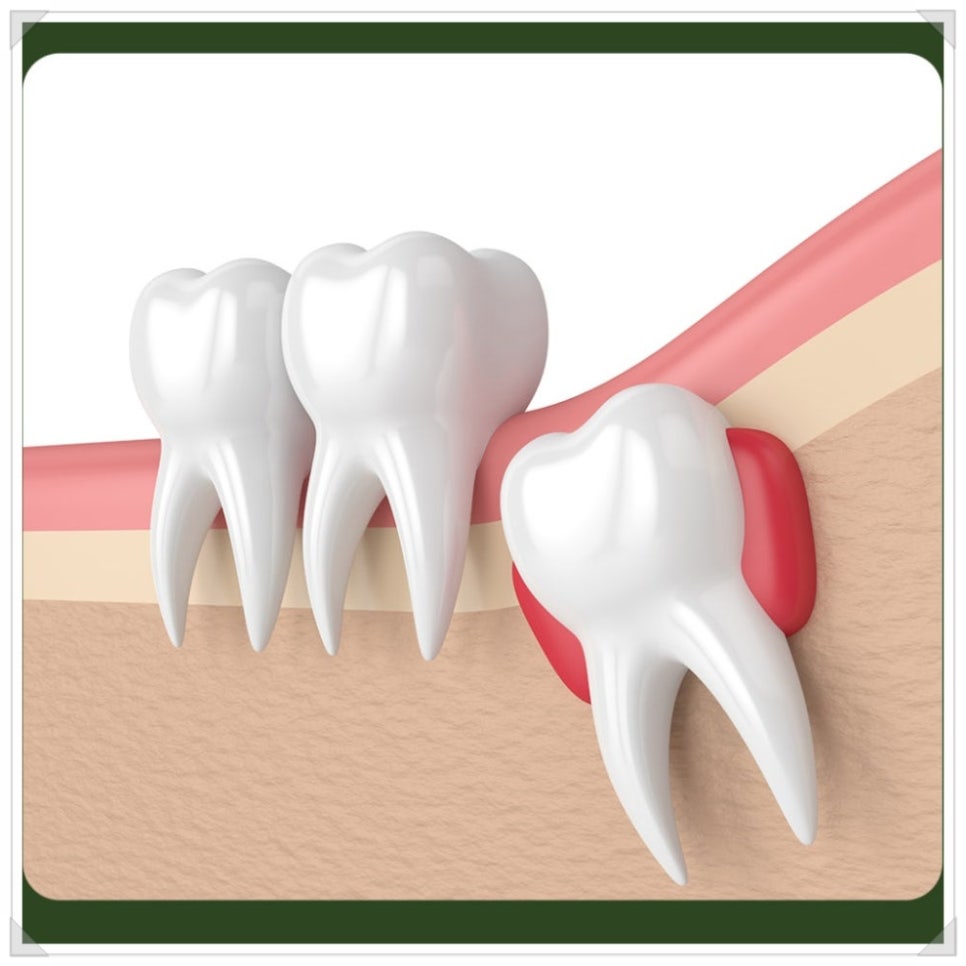 Wisdom Tooth Inflammation: Don’t Leave It Alone—Please Have It Removed! image 2