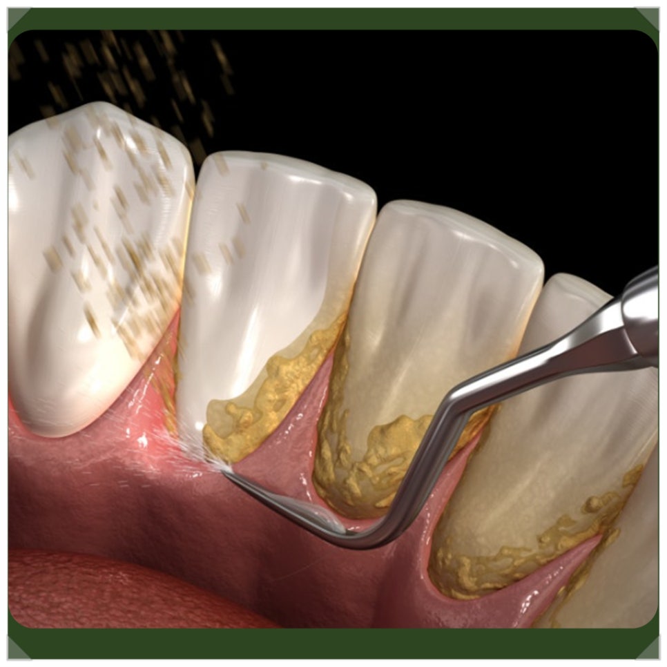 Bleeding After Scaling—Is Something Wrong with the Treatment? If You're Worried image 3