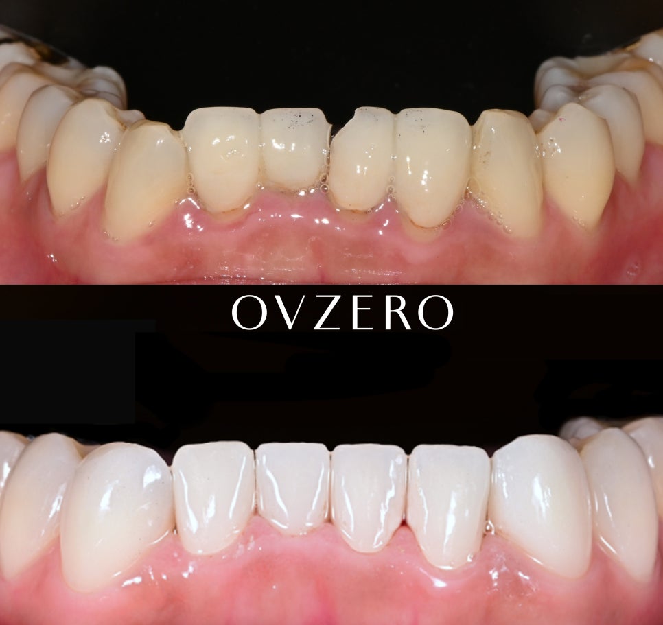 Retreating Front Tooth Damage and Prosthetic Fracture with OVZERO Laminate! image 3