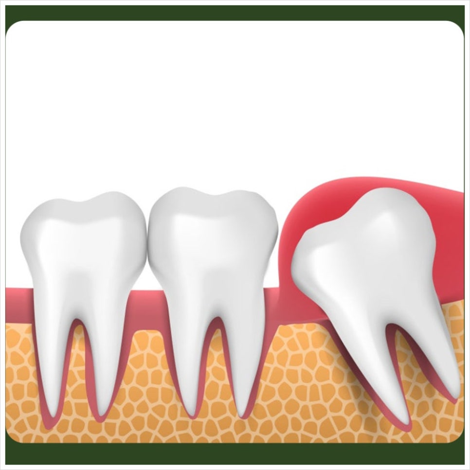Swelling After Wisdom Tooth Extraction: How Can You Reduce It Quickly? image 5