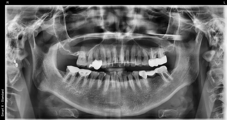 Treatment Process Revealed for a Fall That Injured Both the Front Teeth and Lip image 14
