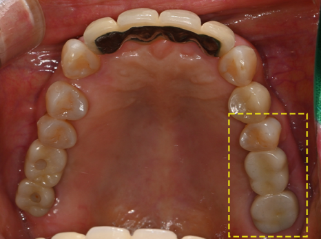 Samjeon Station Implant: Why do some break while others can last a lifetime? image 2