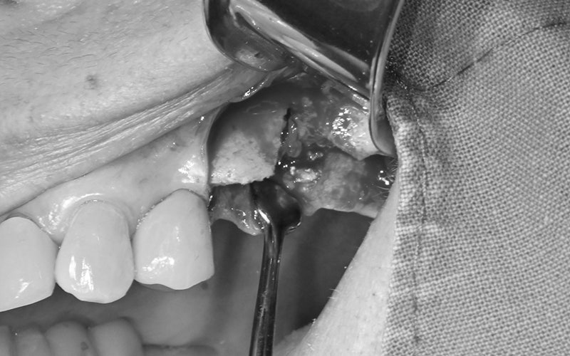 Samjeon Station Implant: Why do some break while others can last a lifetime? image 5