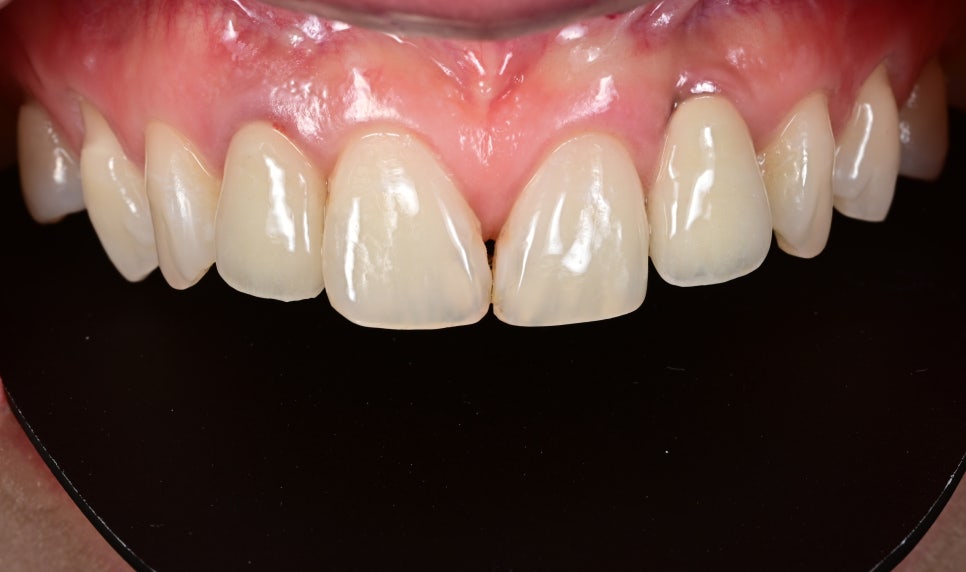 A Case of Simultaneous Laminate and Implant Prosthetic Treatment image 3