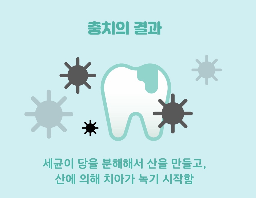 Cavities: Why Do They Form, and How Are They Treated? image 3