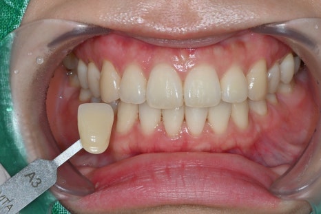 Wedding D-14, It’s Time for Whitening Now!🦷 image 1