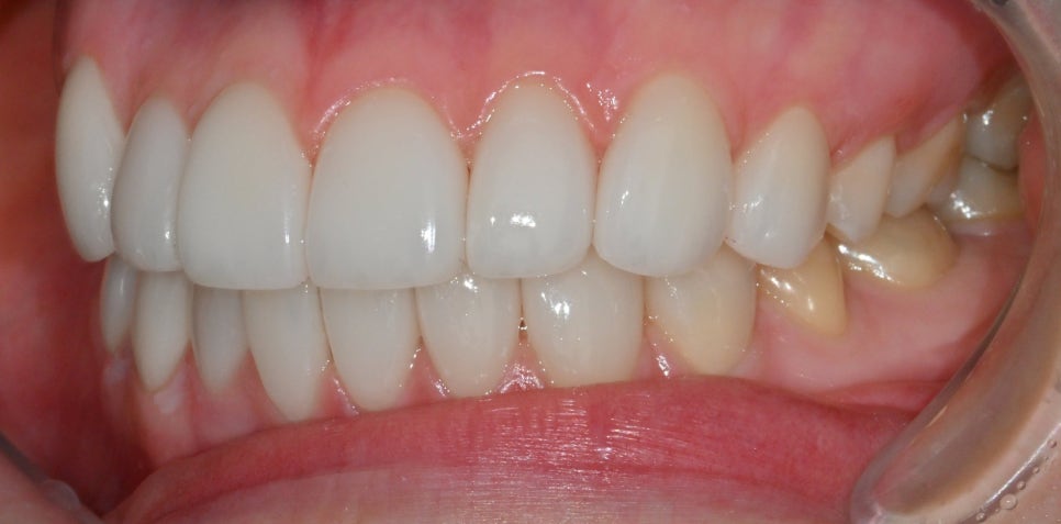Canine Veneers Without Orthodontic Treatment image 10