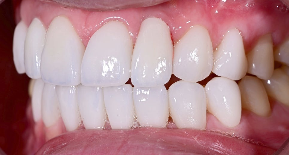 A Case of Simultaneous Laminate and Implant Prosthetic Treatment image 11