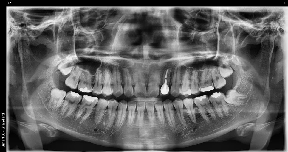Do I Need to Have My Wisdom Tooth Removed Even If It Doesn’t Hurt?🦷Extraction Criteria Explained by an Oral Surgery Specialist image 1