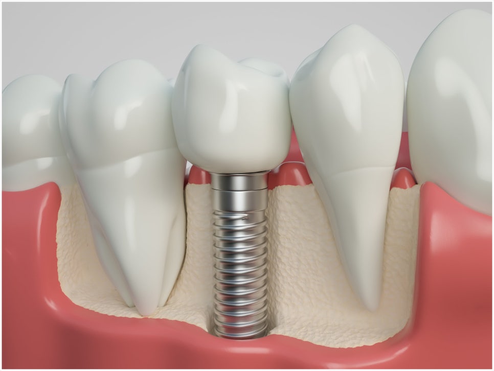 What Is Second-Stage Implant Surgery? Find Out Here! image 5