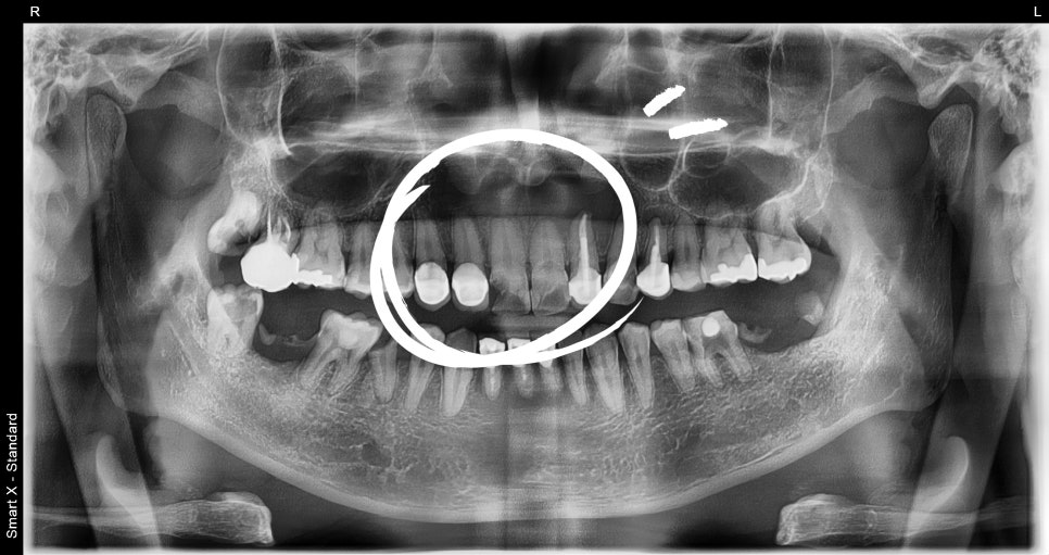 Samjeon Station Dental Clinic: A man in his 30s who visited after breaking his front tooth, and a case in which a cyst was found and implant surgery was also performed image 5