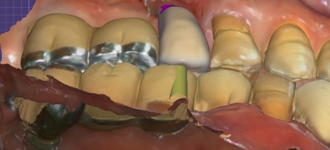 Implants Possible Even in Your 90s: Real Cases from Seoul Above Dental Clinic! image 7