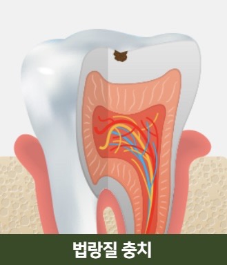 The Power to Protect Natural Teeth: Seoul Orbe Dental Hospital’s Philosophy of Conservative Treatment image 3