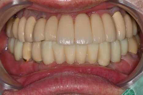 Immediate Implant Placement After Extraction! Seoulove Dental’s Fast Full-Mouth Implant Treatment Completed in 4 Months image 9