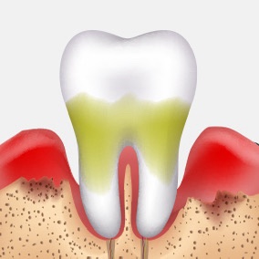 Half of Adults Are Leaving It Untreated?! Restore Healthy Teeth with Gum Treatment image 5