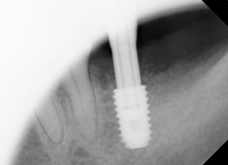 Sammyeon Station Dental Clinic Molars Implant Price, Treatment Process from Extraction to Prosthetics image 9