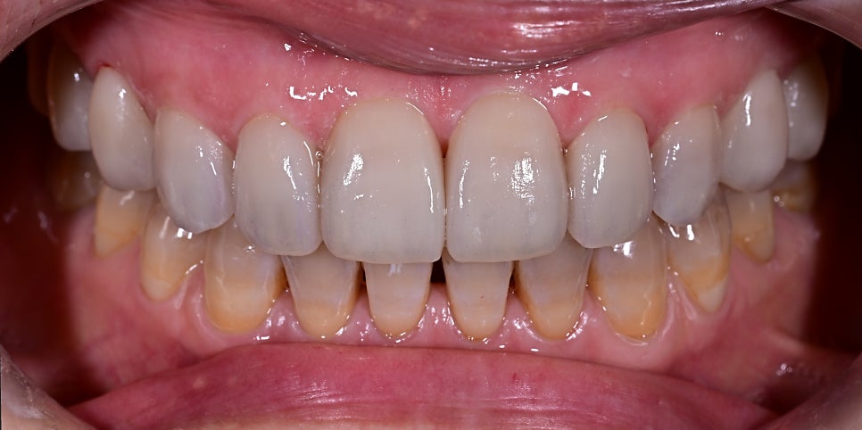 Objet Laminate Treatment for Seniors: Naturally Beautiful, Without Tooth Reduction image 13