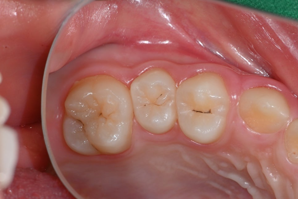 How to Restore Molars with Insurance-Covered Resin for Elementary School Cavities - Seoul of Dental Hospital image 1