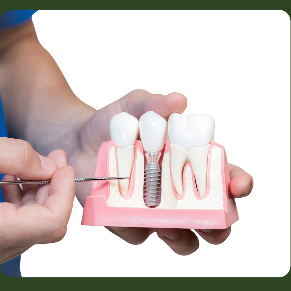 Please Be Careful with Smoking After Dental Implants! image 3