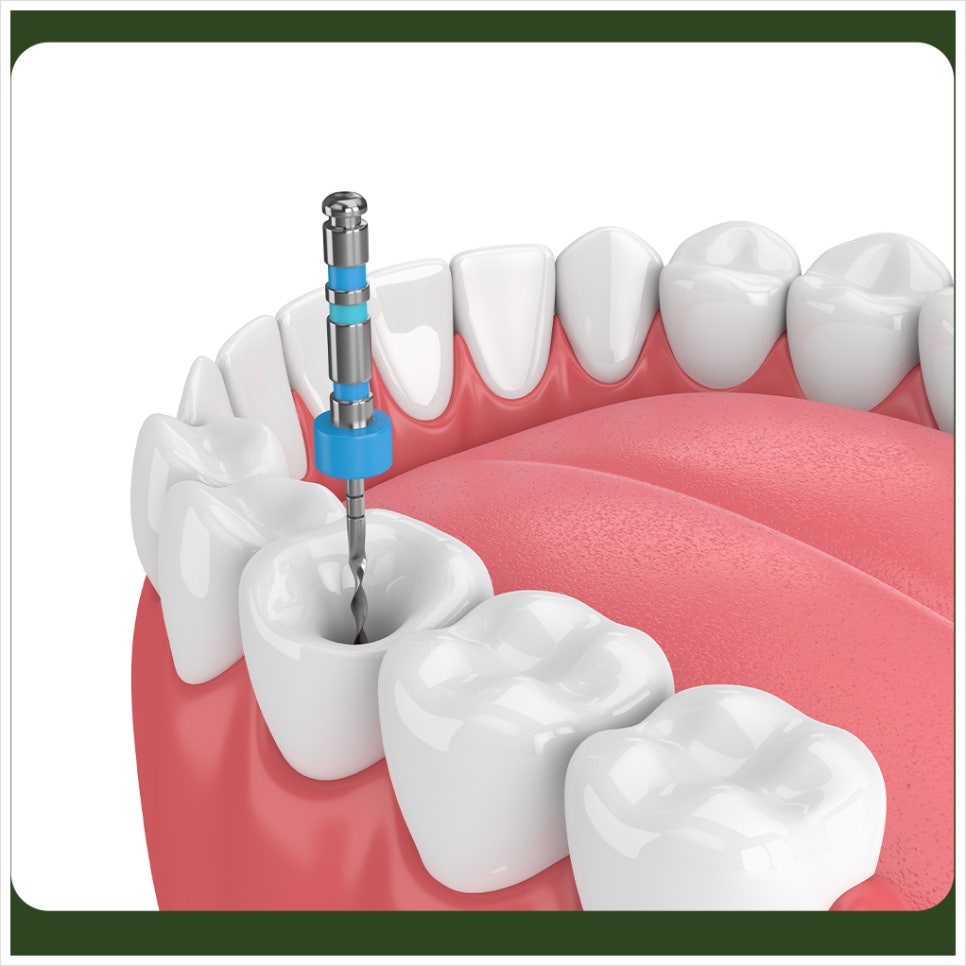 Stopping Root Canal Treatment Is Not Okay — You Must Finish It to the End! image 2