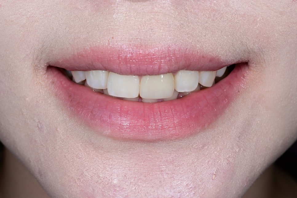 Rabbit Teeth Veneers: Treatment to Achieve Natural Front-Tooth Proportions image 6