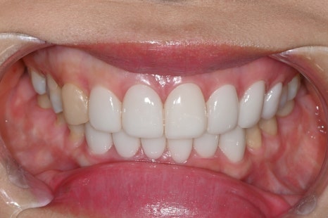 Can a laminate veneer received at another clinic be redone? image 3