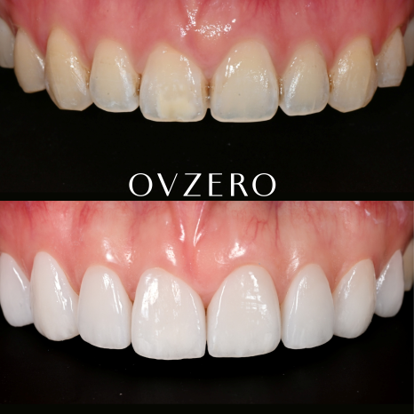 Objeo Laminate Price, and How It Differs from No-Prep Laminate image 3