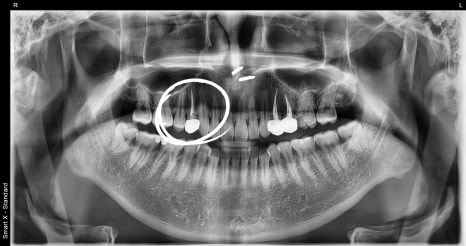 Why Cracked Molar Pain Means You May Need Root Canal Treatment image 8