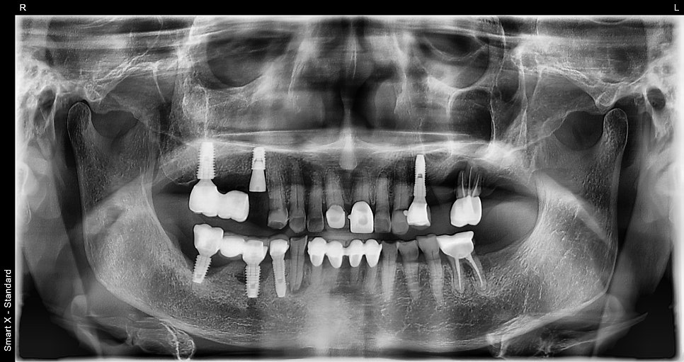 Implants Possible Even in Your 90s: Real Cases from Seoul Above Dental Clinic! image 3