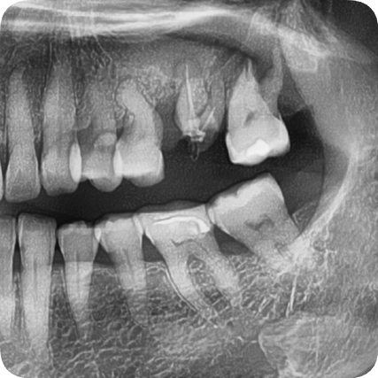 Songpa Dental Clinic: Is Insurance-Covered Implant Treatment Possible? image 7
