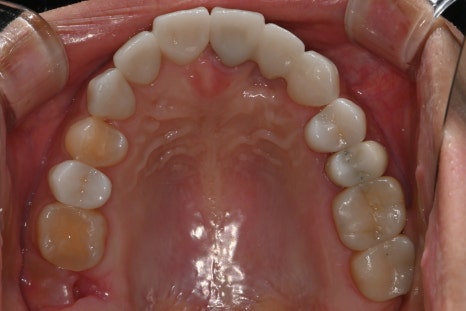 Possible Front Tooth Prosthetic Replacement Even While Staying Abroad! A Natural Smile Completed on a Short Schedule✨ image 4