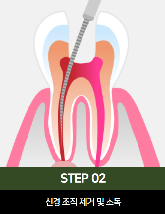 The Power to Protect Natural Teeth: Seoul Orbe Dental Hospital’s Philosophy of Conservative Treatment image 12