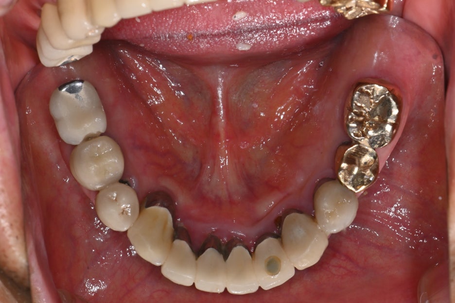 Why the First Root Canal Procedure Must Be Handled by a Specialist image 5