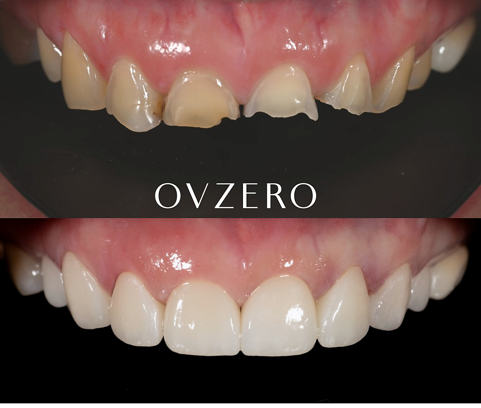 Treatment with Objetto Laminate Veneers After a Chipped Front Tooth image 16