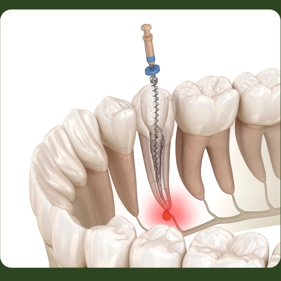 치아 염증, 뿌리끝에 생겼다면? 관련 이미지 3
