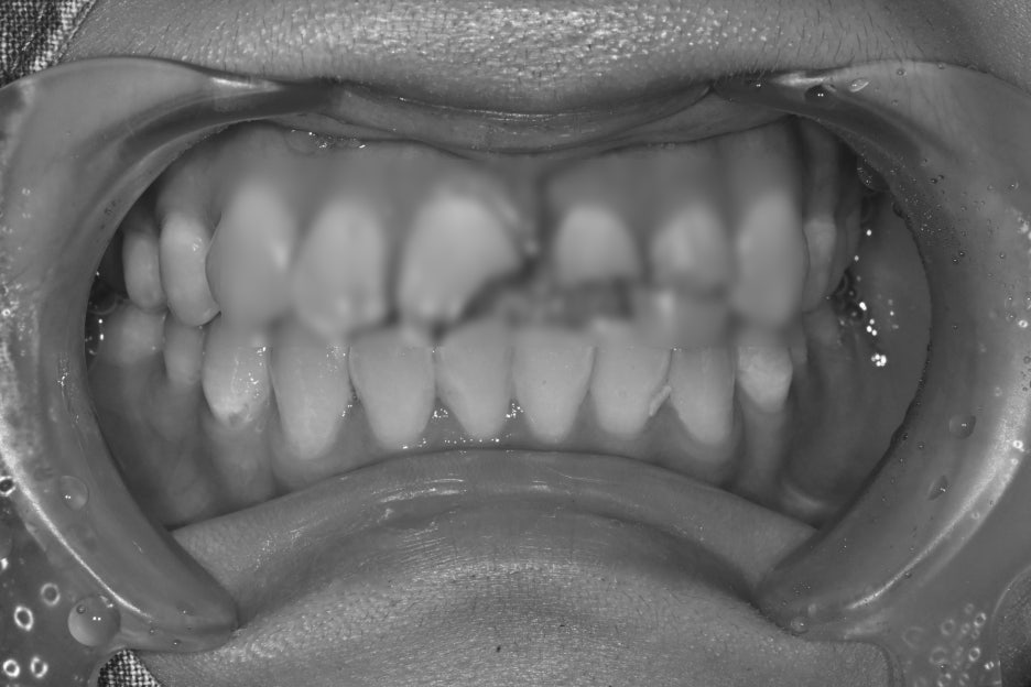 Songpa Dental Clinic, a Case of Crown Restoration After Root Canal Treatment for a Woman in Her 20s With a Broken Front Tooth image 14