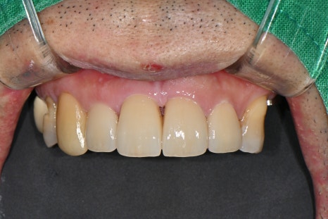 A Broken Front Tooth from a Fall, Restored Along with the Gums! Emergency Treatment Report from Seoul Ob Dental Hospital image 6