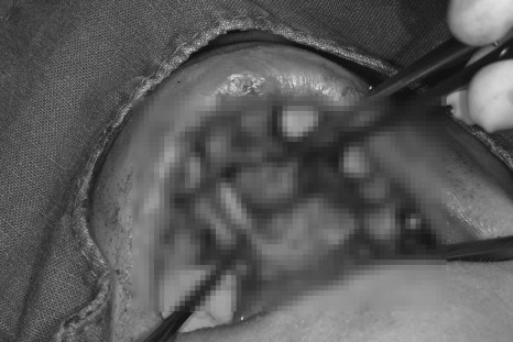 Samjeon Station Dental Clinic: A man in his 30s who visited after breaking his front tooth, and a case in which a cyst was found and implant surgery was also performed image 2